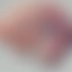 El hombre más joven Diagnósticado con Alzheimer