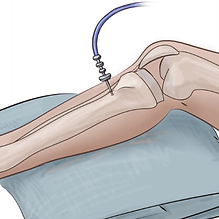 Intraosseous Infusion Needle