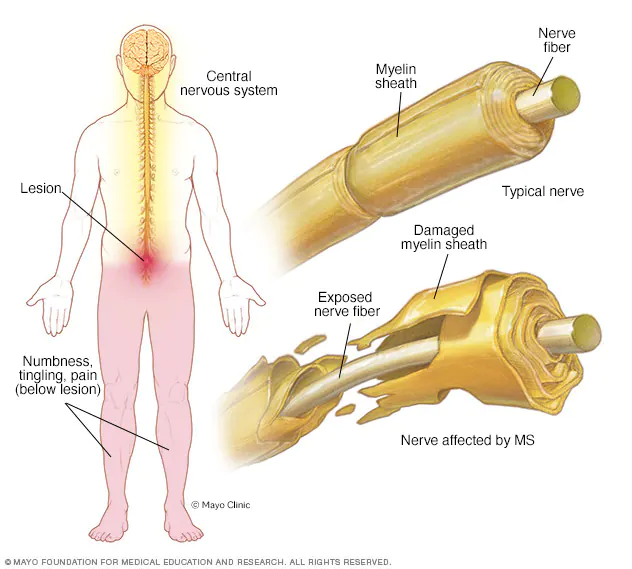 Healthy Myelin Sheath vs. Damaged Myelin Sheath