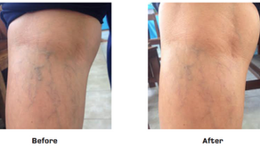 Results of using Muscel + Hydro for about 15 minutes