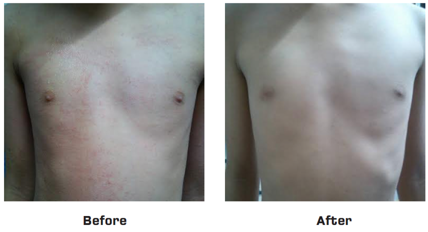 Healed Rashes Rashes healed