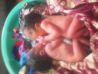 Des bébés siamois nés à Kindia se trouve au CHU de Donka