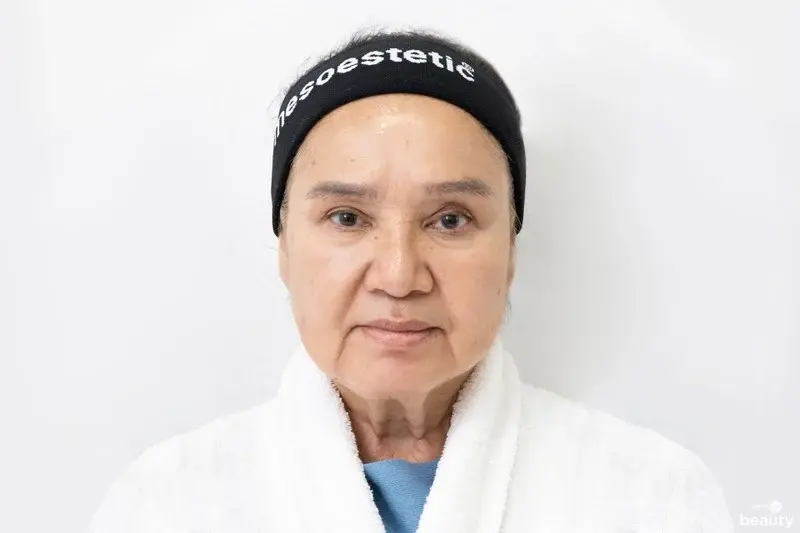 ฝ้า
