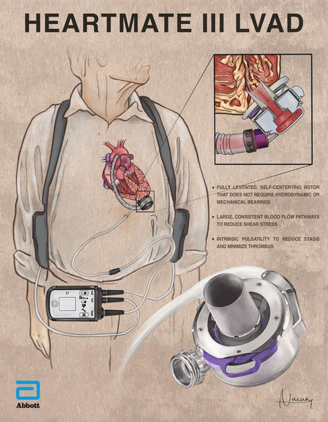 a drawing of a heart with a device attached to it