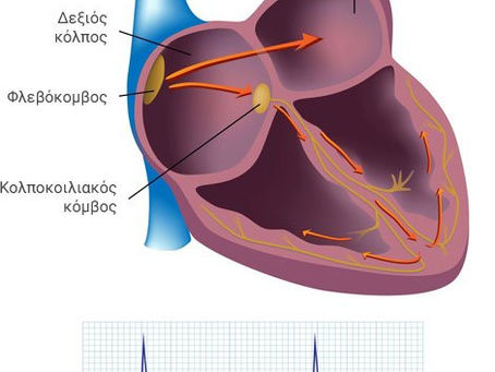 Δυσλειτουργία Φλεβοκόμβου, Σύνδρομο Ταχυκαρδίας – Βραδυκαρδίας