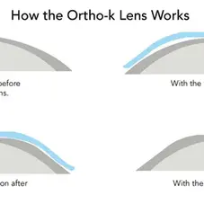 What is Ortho-K? (A "Retainer" for Your Eyes)