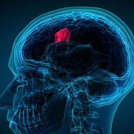 Brain Tumor