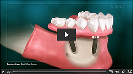 Fixed Hybrid Denture.png
