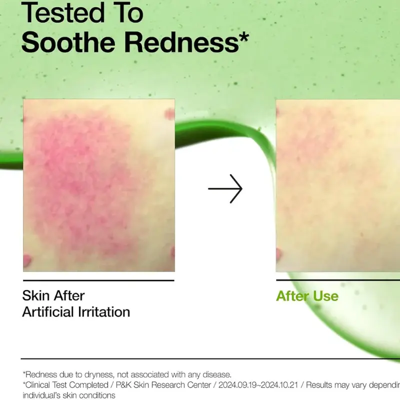 Miniature : avant-apres-rosacee-et-taches-brunes-anua-azelaic-acid-10-hyaluronic-redness-soothing-serum