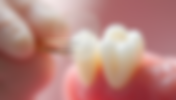 Discover the Benefits of Ultra-Thin Porcelain Veneers for a Stunning Smile Transformation