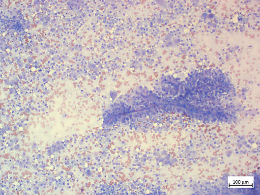 Leydigzelltumor x100