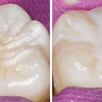sellado-de-fisura-antes-despues.jpg