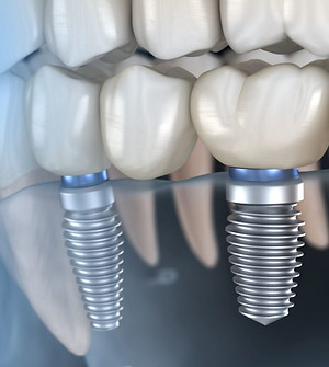 implantología-dental-1024x718.jpeg