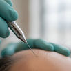 Scar Free Hair Restoration: Achieving Permanent Density Without Visible Marks
