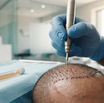 Combining PRP with Hair Transplant: Maximising Follicle Survival in 2026