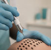 Hair Transplant Recovery Time: A Comprehensive Month-by-Month Guide