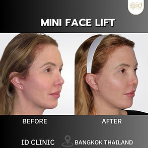 LINE_ALBUM_mini face lift_250820_10.jpg