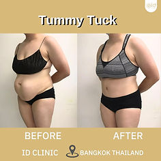 LINE_ALBUM_TUMMY TUCK_250820_2.jpg