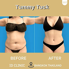 LINE_ALBUM_TUMMY TUCK_250820_1.jpg