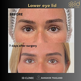 LINE_ALBUM_eylid surgery_250820_1.jpg