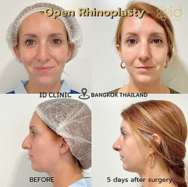 LINE_ALBUM_RHINOPLASTE and nose implant_250820_1.jpg