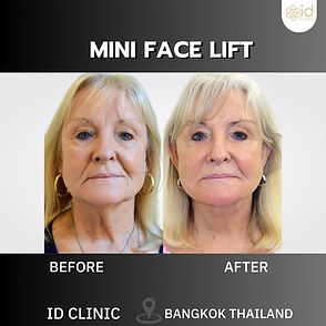 LINE_ALBUM_mini face lift_250820_9.jpg