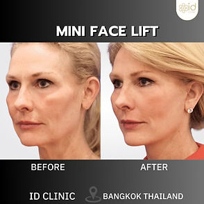 LINE_ALBUM_mini face lift_250820_2.jpg