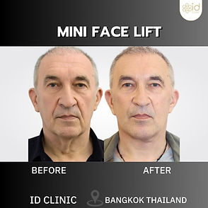 LINE_ALBUM_mini face lift_250820_6.jpg