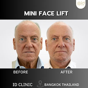 LINE_ALBUM_mini face lift_250820_7.jpg