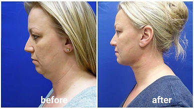 LINE_ALBUM_liposuction underchin_250820_4.jpg