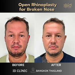 LINE_ALBUM_RHINOPLASTE and nose implant_250820_6.jpg