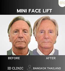 LINE_ALBUM_mini face lift_250820_3.jpg