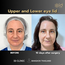 LINE_ALBUM_EYELID SURGERY_250820_1.jpg