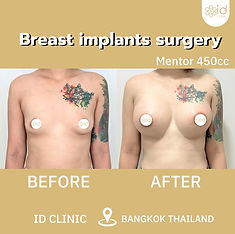 LINE_ALBUM_Breast implants surgery_250820_5.jpg