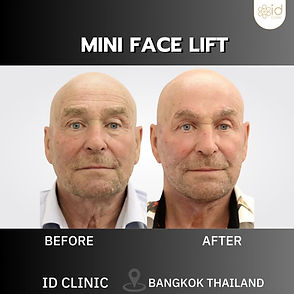 LINE_ALBUM_mini face lift_250820_5.jpg