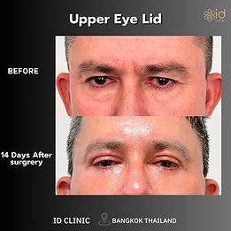 LINE_ALBUM_EYELID SURGERY_250820_10.jpg