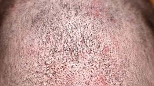 Zits On Scalp