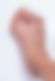 Bunion stage 4