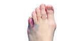 Adult foot with Chilblains