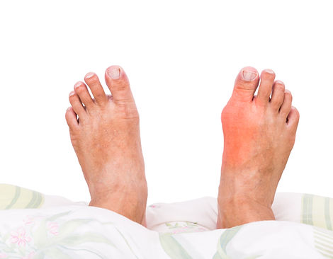 Feet with gout