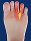 Mortons neuroma swelling at nerve site
