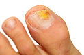 Fungal Nail Infection