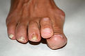 Hallux rigidus