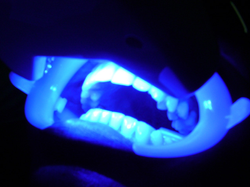 Aplicação do Laser