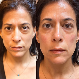 BeRejuved Medical Spa Juvderm Lip Injections Before and After