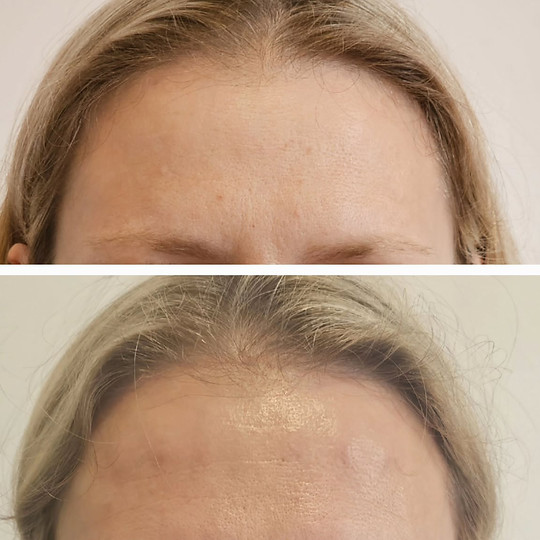 Botox 3 Upper Areas before and after