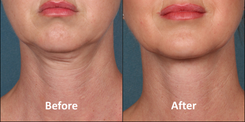 Anti-wrinkle injections before and after photos