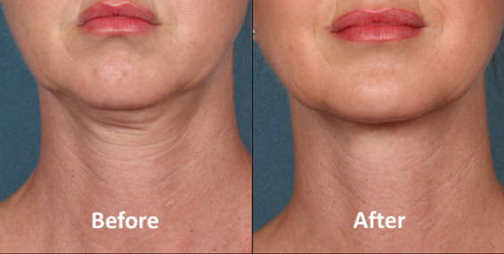 Nefertiti Lift Botox Neck lift