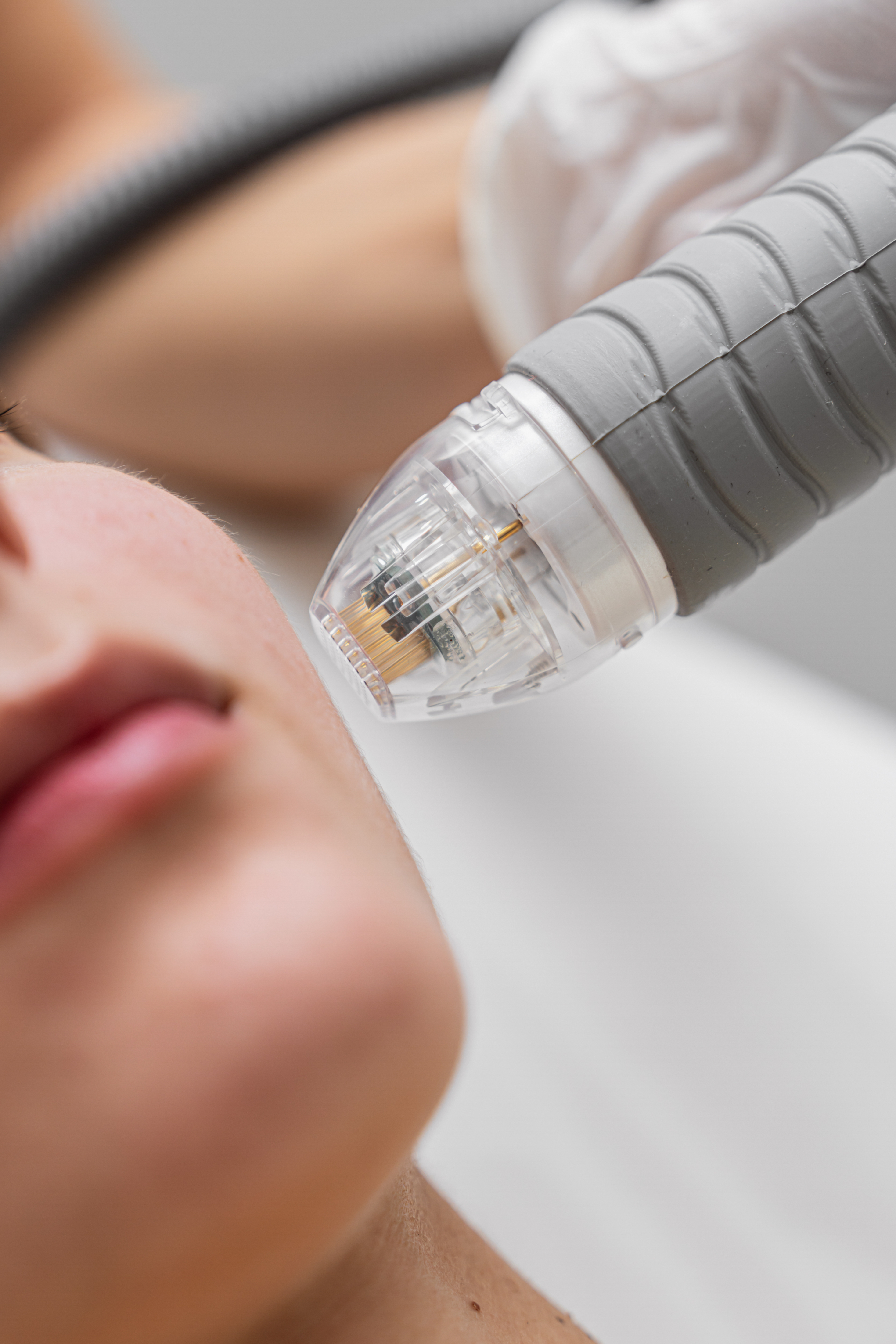 RF microneedling skin tighening
