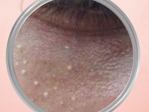 Sassy Guide to Calcium Deposits